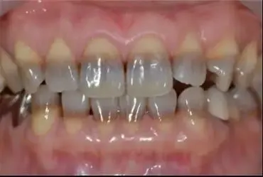 Stained Teeth